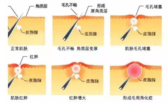报酬甚么会起鸡皮疙瘩