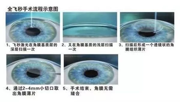 报酬甚么会远视,远视眼构成的道理是甚么