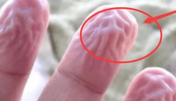 为甚么洗完澡手指是皱的,手指和脚指爱褶皱是怎样回事
